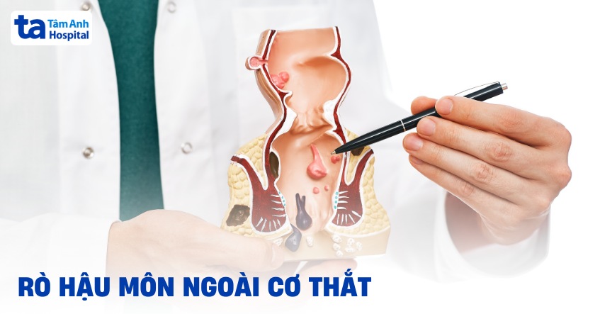 Rò hậu môn ngoài cơ thắt: Nguyên nhân, triệu chứng, phòng ngừa