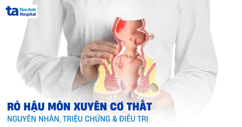 Rò hậu môn xuyên cơ thắt: Nguyên nhân, triệu chứng, phòng ngừa