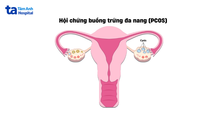 Rối loạn chu kỳ kinh nguyệt là một trong những biểu hiện của đa nang buồng trứng
