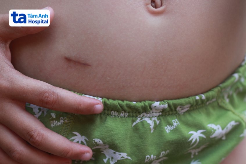 Sẹo để lại do phẫu thuật viêm ruột thừa ở trẻ
