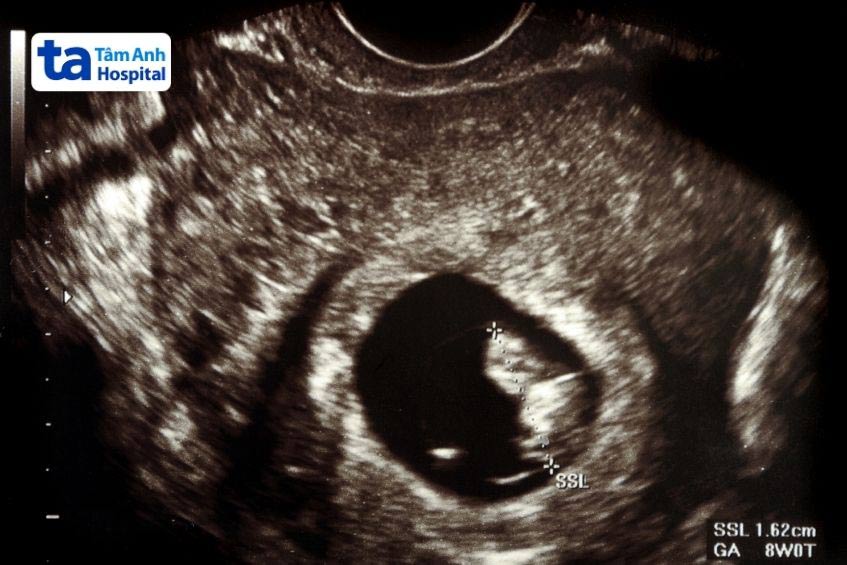 siêu âm của thai 9 tuần tuổi