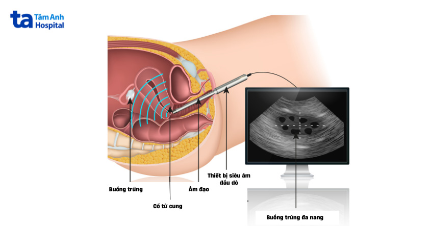 Siêu âm đầu dò âm đạo giúp phát hiện đa nang buồng trứng