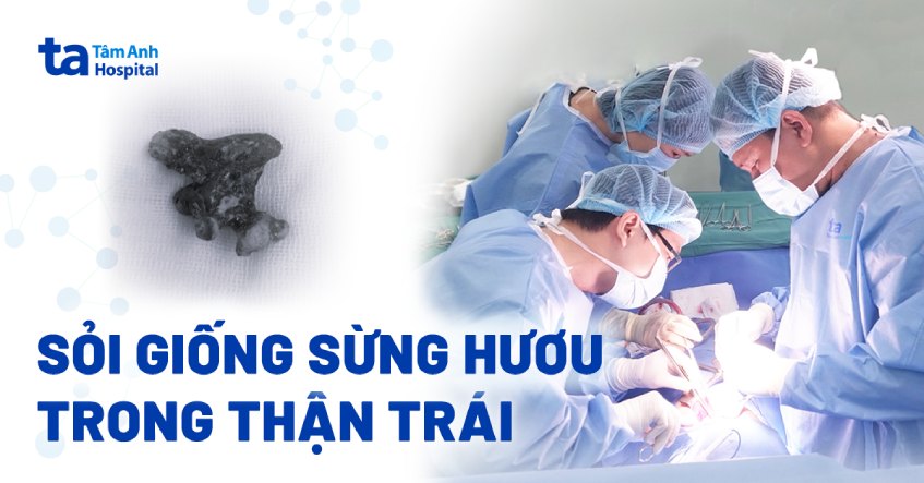 Sỏi thận phân 5 nhánh giống sừng hươu