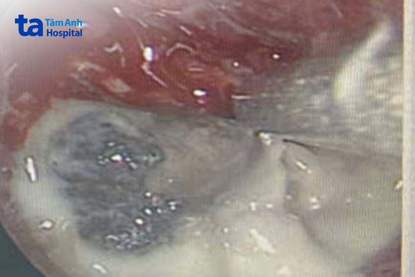 sỏi mũi kích thước khoảng 3x2 cm