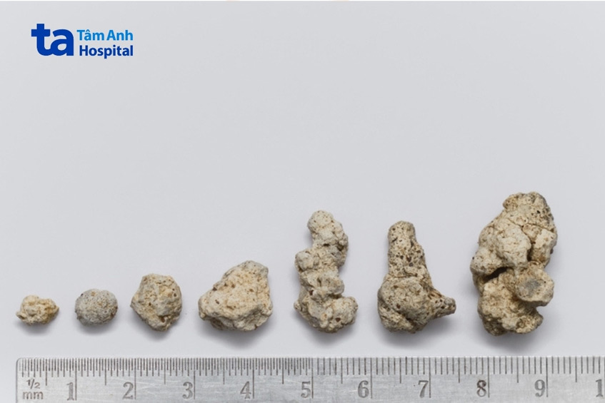 sỏi tiết niệu có nguy hiểm không phụ thuộc vào nhiều yếu tố