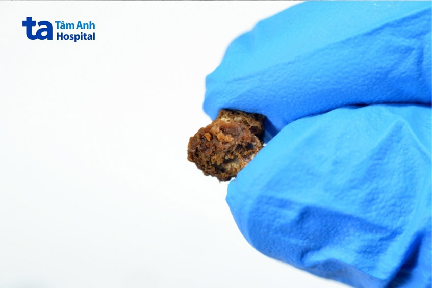 sỏi tiết niệu hình thành do sự lắng đọng và kết tinh của các chất