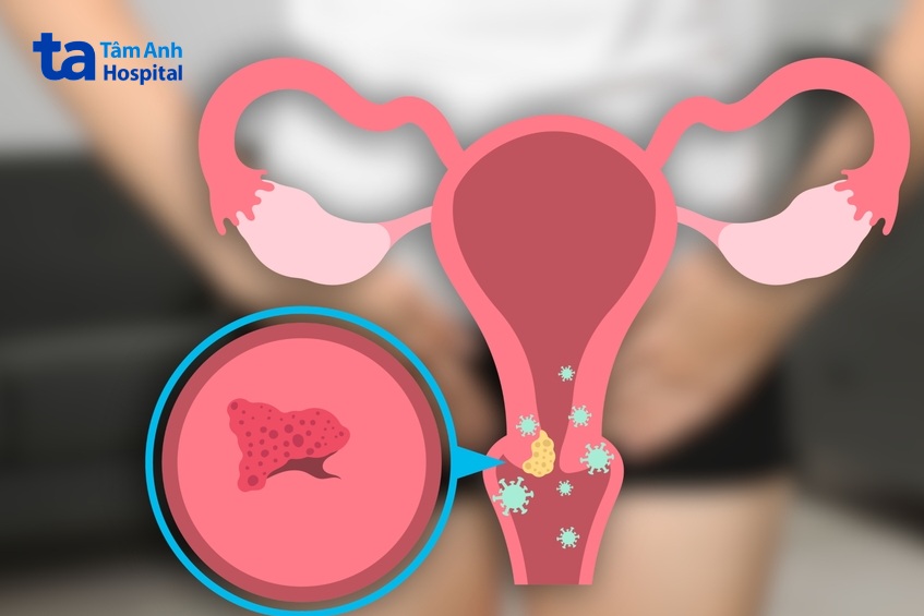 sùi mào gà có tự hết được không