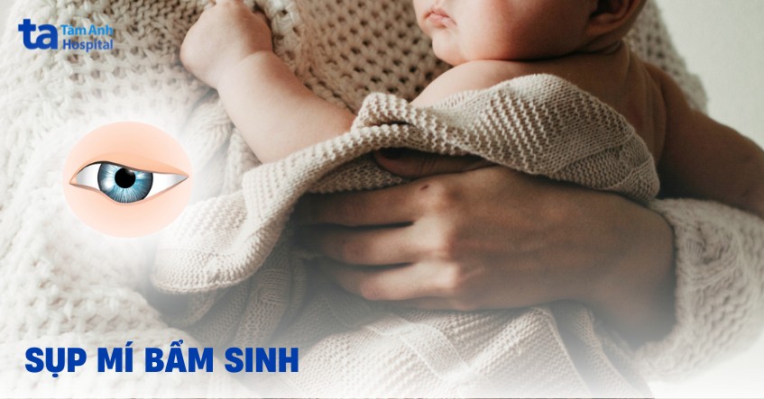 Sụp mí bẩm sinh: Nguyên nhân, chẩn đoán và cách điều trị