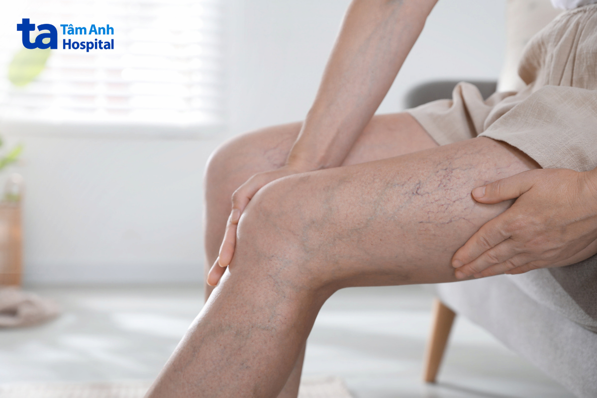 suy giãn tĩnh mạch ở chi dưới 