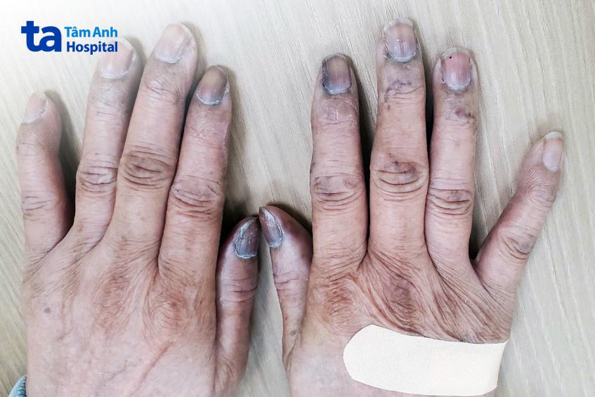 tăng sắc tố da ở đầu ngón tay người bệnh