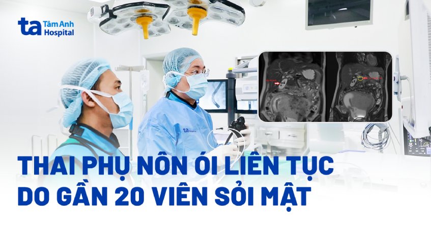 thai phụ bị sỏi mật