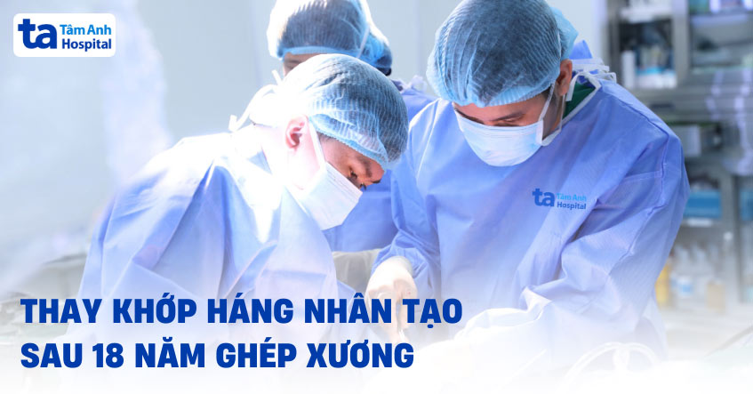 Thay khớp háng nhân tạo sau 18 năm ghép xương