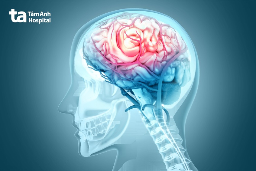 thiếu máu não có thể gây đau đầu sau khi ngủ trưa