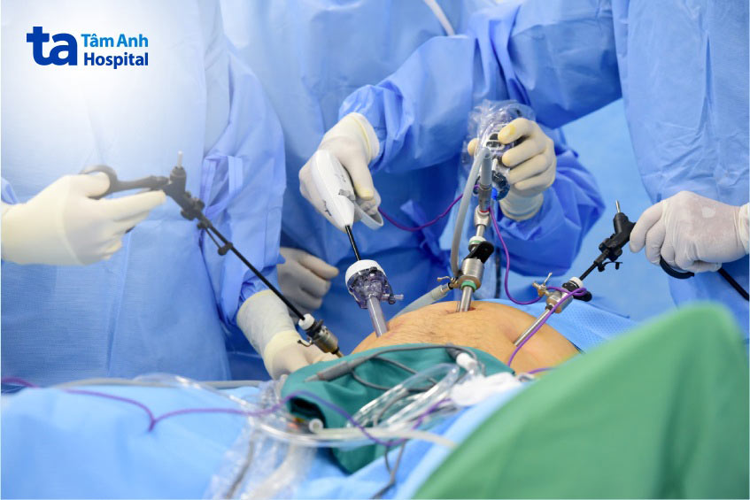 thực hiện mổ nội soi cho người bệnh sỏi tiết niệu