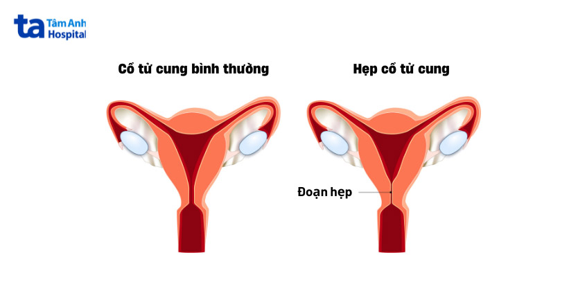 tình trạng cổ tử cung hẹp ở phụ nữ