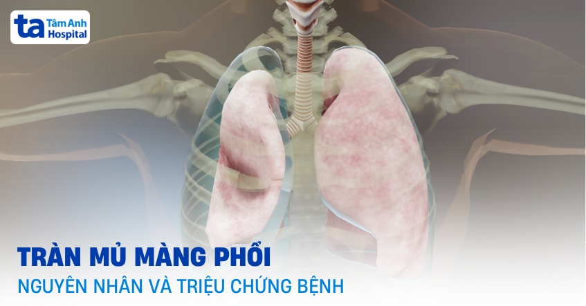 Tràn mủ màng phổi