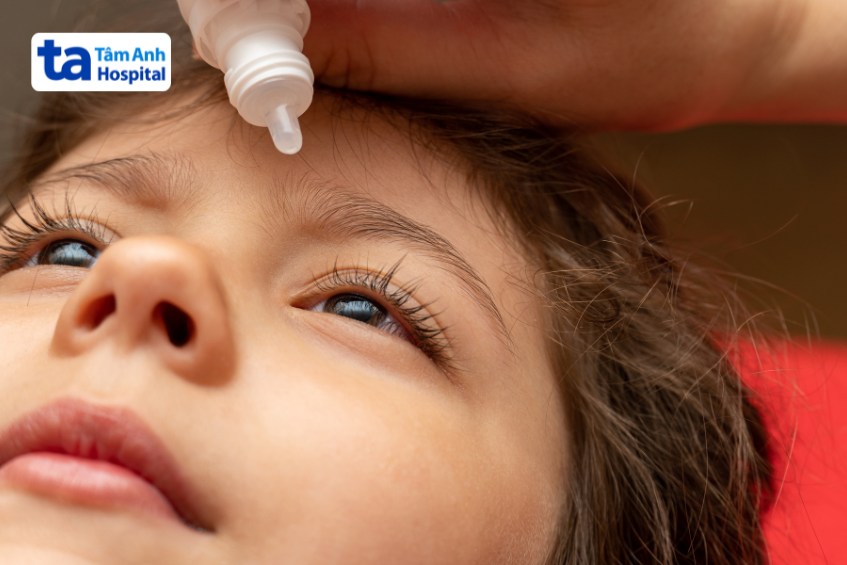 Trẻ đau mắt đỏ do virus có thể được bác sĩ hướng dẫn vệ sinh