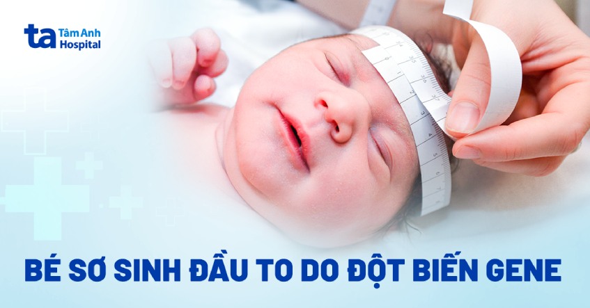 Trẻ mắc hội chứng đầu to do đột biến gen