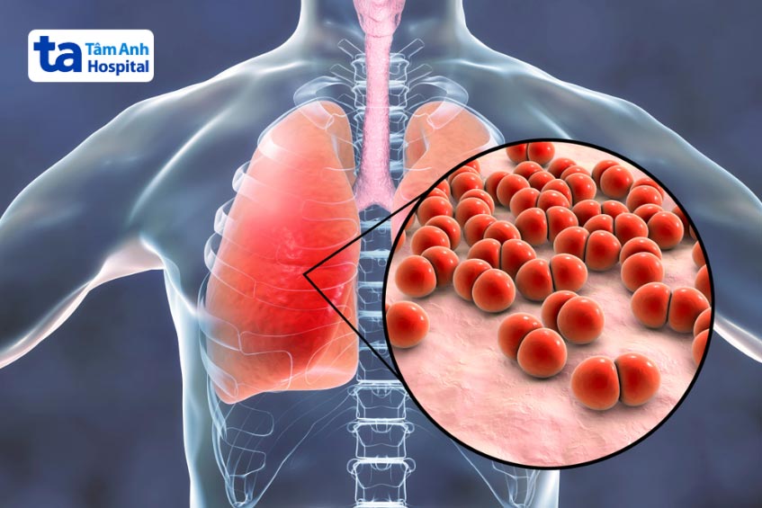 trẻ nhỏ và người già viêm phổi do phế cầu có tỷ lệ tử vong cao