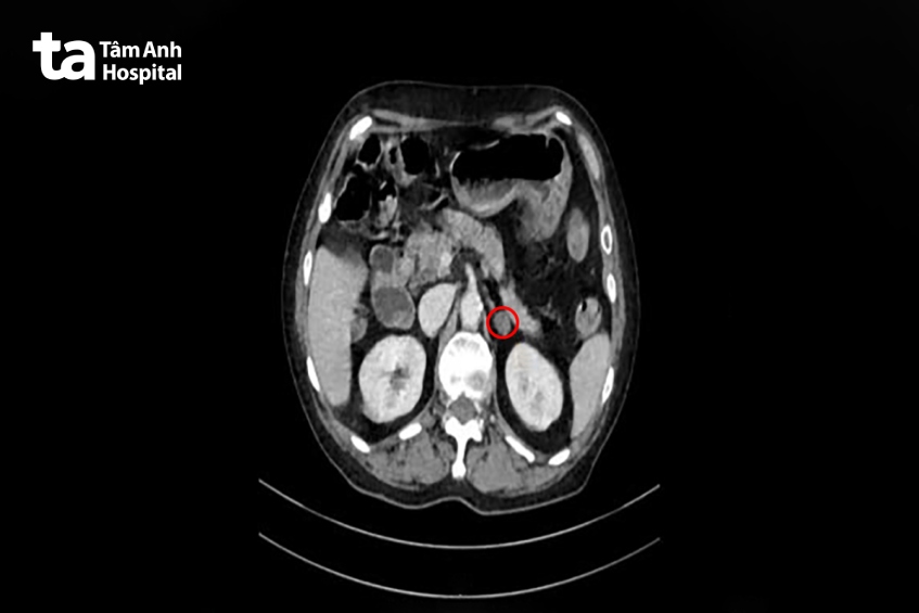 trên phim CT scan