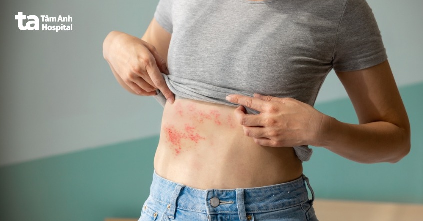 triệu chứng dị ứng thuốc bị ngứa