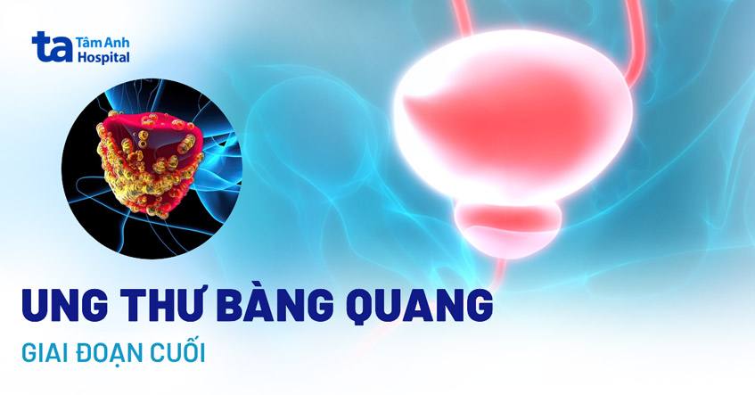 Triệu chứng ung thư bàng quang giai đoạn cuối và cách điều trị