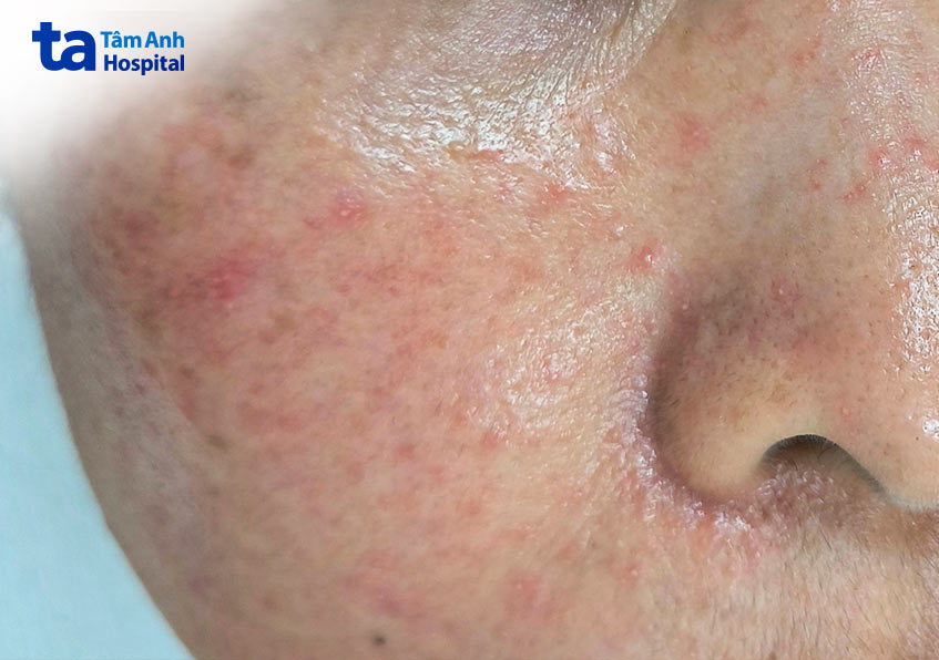 trường hợp bị mẩn đỏ li ti sau tự peel da tại nhà