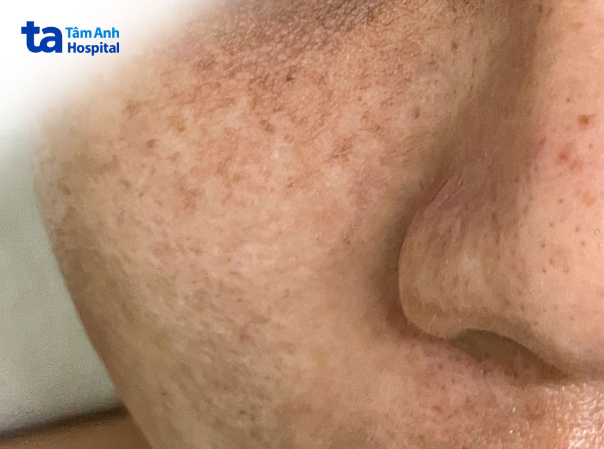 trường hợp bị tăng sắc tố sau viêm