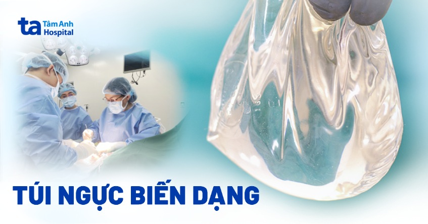 Túi ngực biến dạng có nguy hiểm không? Dấu hiệu cần thay thế