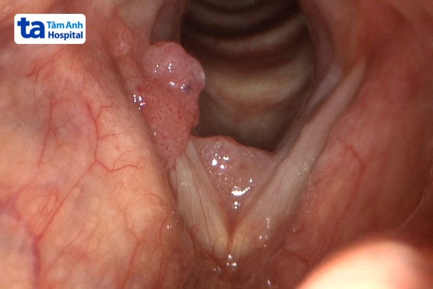 u nhú tại bộ phận thanh quản