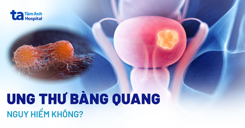 Ung thư bàng quang có nguy hiểm không? Biện pháp phòng ngừa