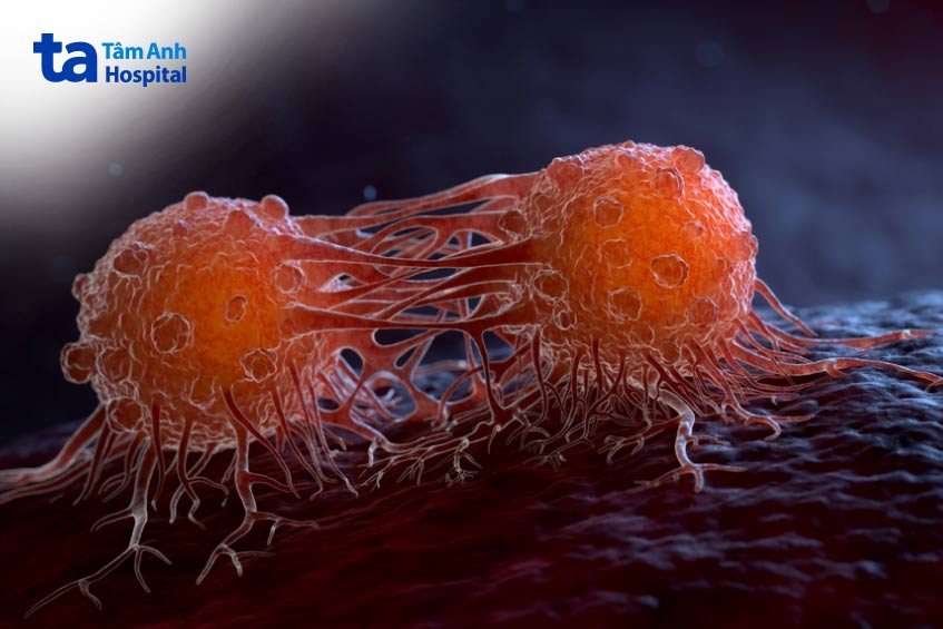ung thư bàng quang nếu không điều trị kịp thời có thể xảy ra biến chứng