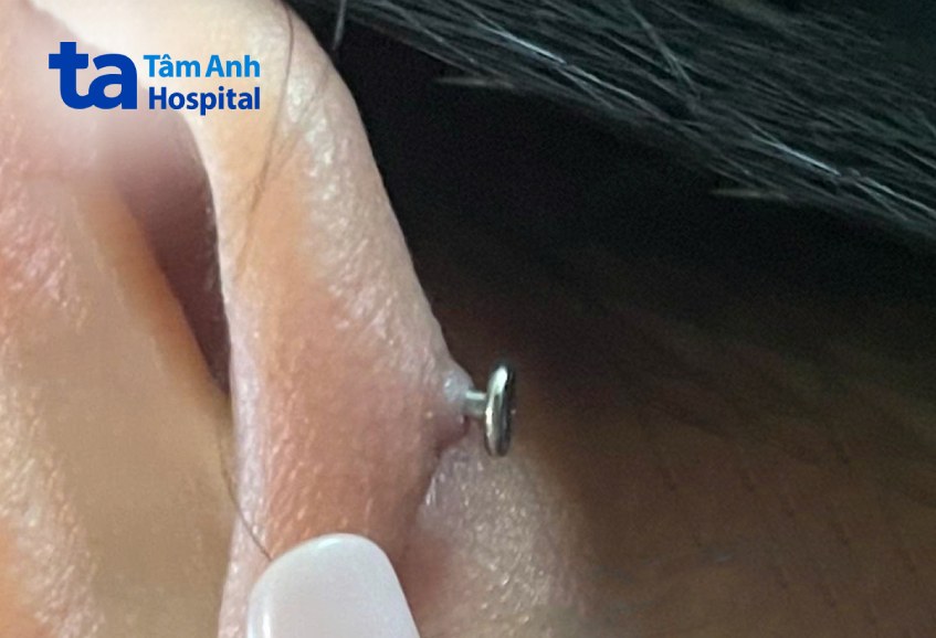 vành tai bị sưng phồng
