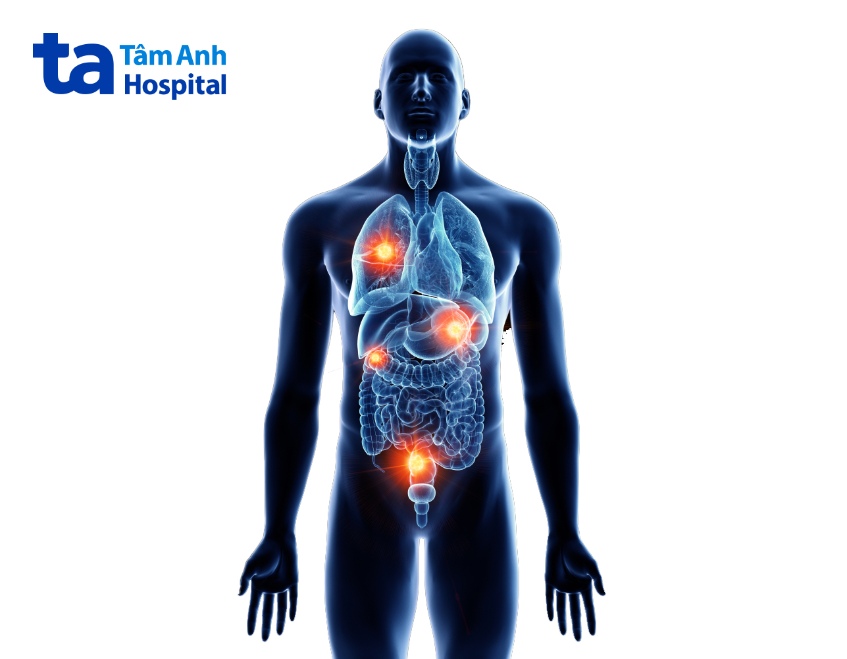 vị trí ung thư trực tràng di căn phổ biến