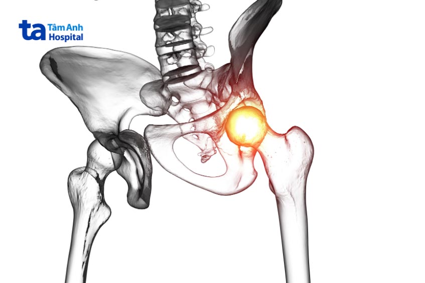 Viêm cơ hoại tử qua trung gian có thể gây tàn tật nếu điều trị muộn