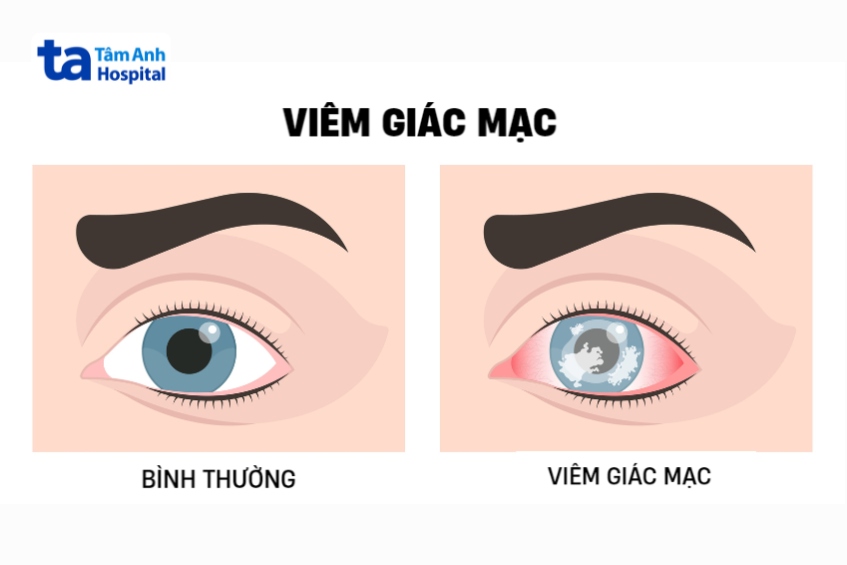 Viêm giác mạc gây cảm giác cộm, khó chịu ở mắt, đỏ mắt