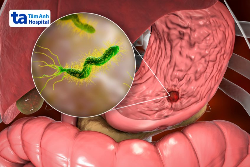 Viêm loét dạ dày tá tràng do sự tấn công của vi khuẩn HP