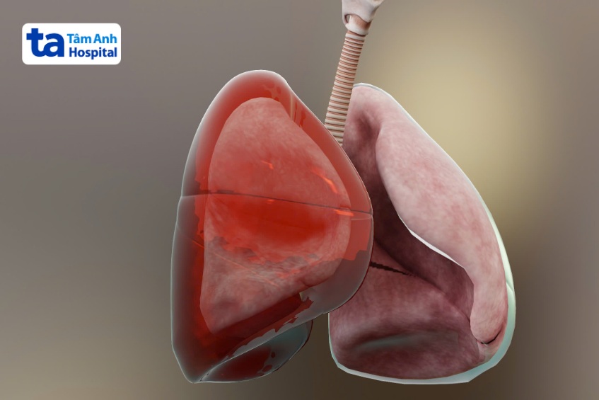 Viêm mủ màng phổi không phải là bệnh lý lây nhiễm