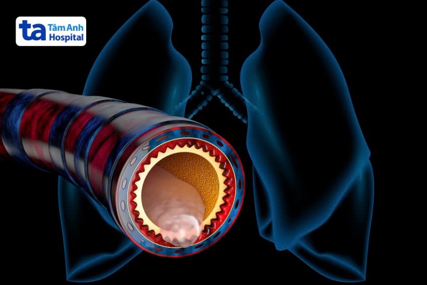Viêm phế quản cấp là tình trạng bệnh lý phổ biến