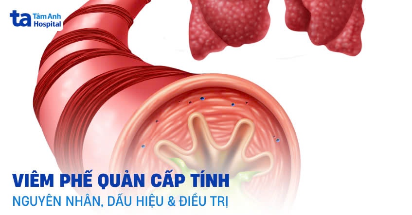 Viêm phế quản cấp tính: Nguyên nhân, dấu hiệu và cách điều trị