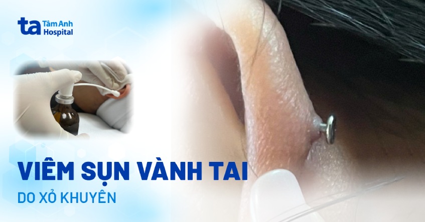 Nhiều người trẻ viêm sụn vành tai do xỏ khuyên tai