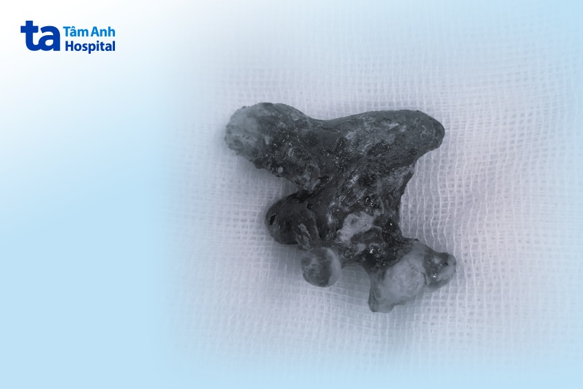 viên sỏi san hô giống sừng hươu