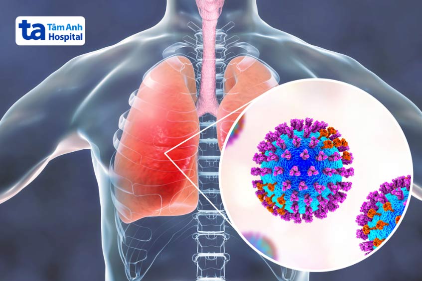 virus a h3n2 là một phân nhóm cúm a