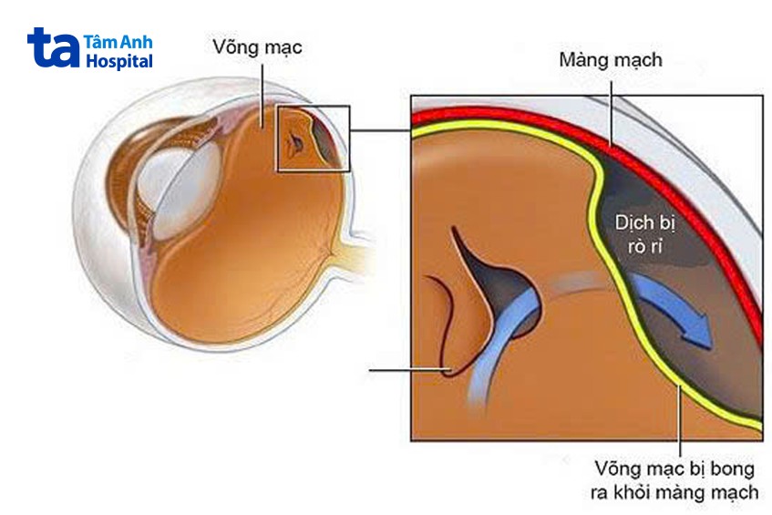 võng mạc bong khỏi màng mạch