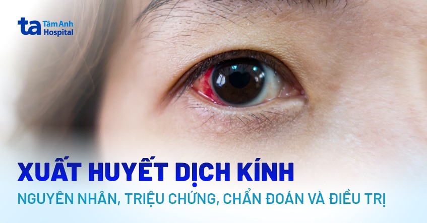 xuất huyết dịch kính