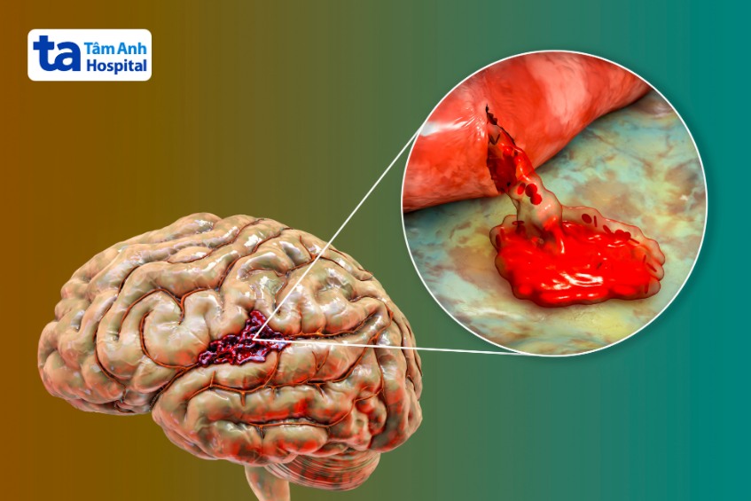 xuất huyết não gây tổn thương não