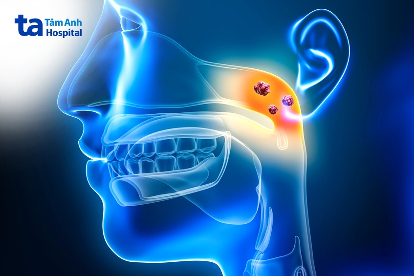 yếu tố làm tăng nguy cơ ung thư vòm họng