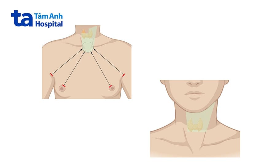 2 phương pháp mổ nội soi u tuyến giáp