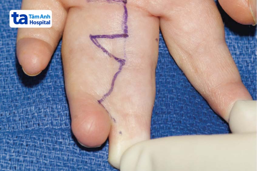 Thiết kế vạt da mặt gan 