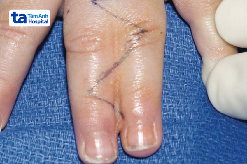 Thiết kế vạt da mặt mu ngón